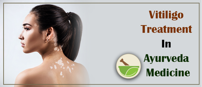 https://rkgdeal.com/uploads/17088441059636Vitiligo-treatment-in-ayurveda.jpg